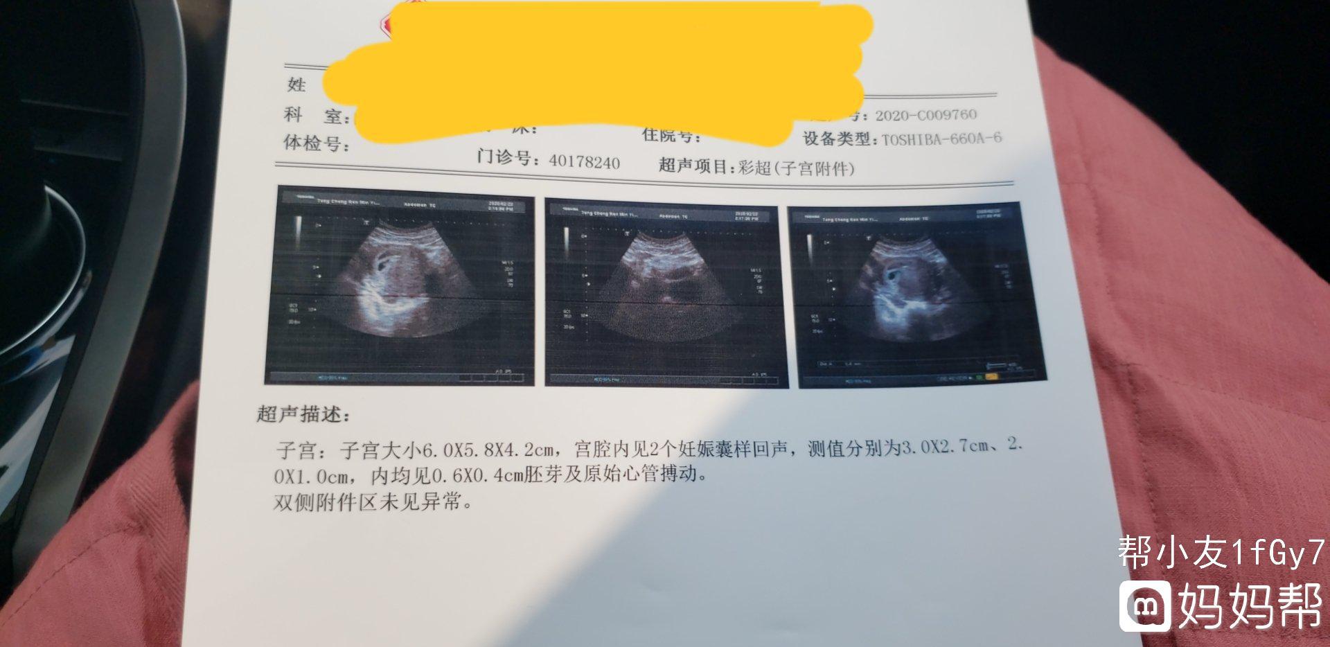 在单亲家庭长大的山东30岁美女坚持不结婚，通过做供卵试管三代代生生下混血三胞胎