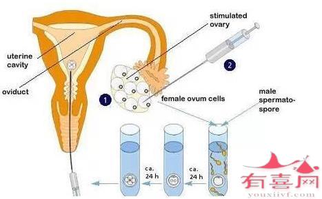 试管婴儿人工降调是什么意思