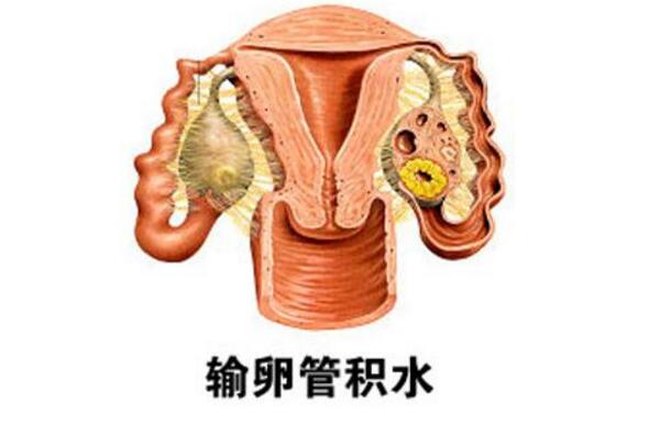 卵巢囊肿影响试管成功率吗？卵巢囊肿会有哪些影响？