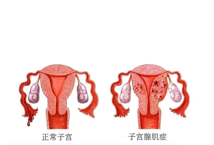人工授精导管使用方法(人工授精导管)