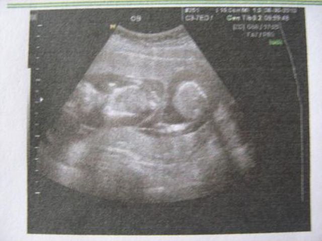 哈尔滨哪个医院可以男子代生婴儿-第三代代怀成功率是否适用于乙肝患者