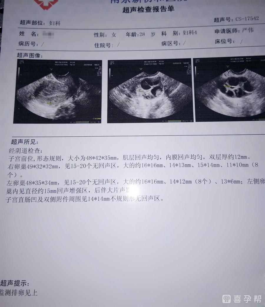 试管促排看不见一边的卵巢