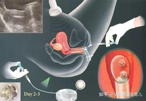 女方13号染色体平衡易位助孕代生产医院排名的成功率有多少